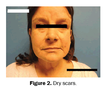 clinical-medical-Dry-scars
