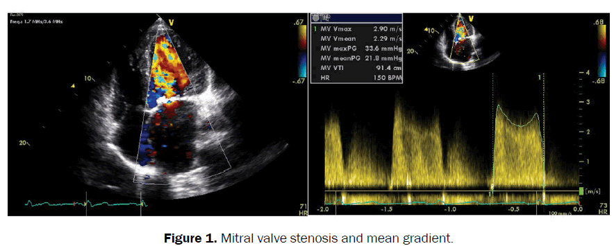 clinical-medical-Mitral-valve
