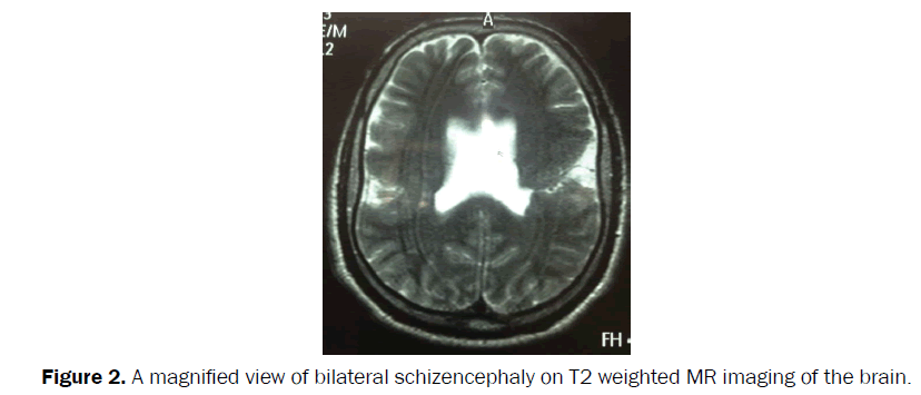 clinical-medical-bilateral-schizencephaly