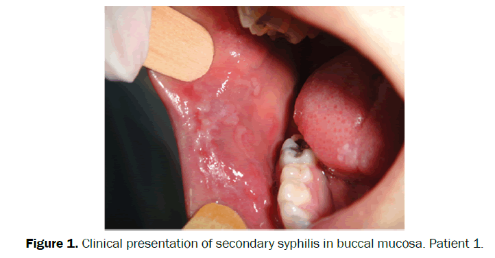 clinical-medical-secondary-syphilis