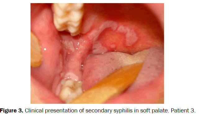 clinical-medical-soft-palate