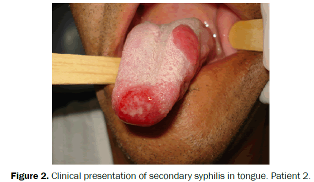 clinical-medical-syphilis-tongue