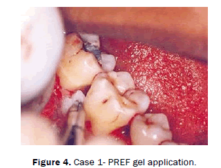 dental-sciences-Case-gel-application