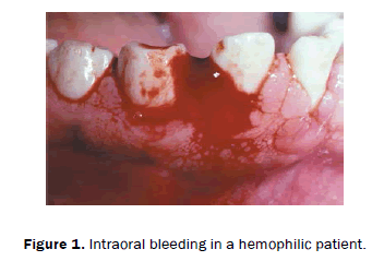 dental-sciences-Intraoral-bleeding-hemophilic