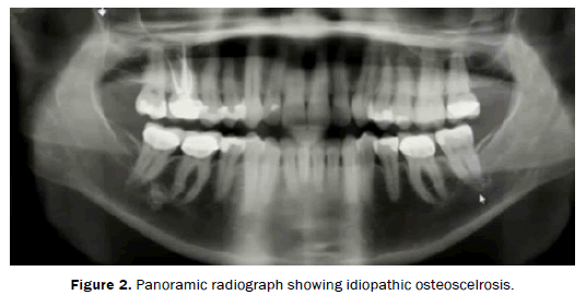dental-sciences-Panoramic-radiograph-idiopathic-osteoscelrosis