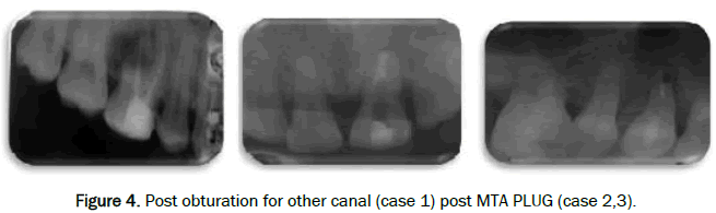dental-sciences-Post-obturation-canal-post