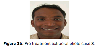 dental-sciences-Pre-treatment-extraoral-photo