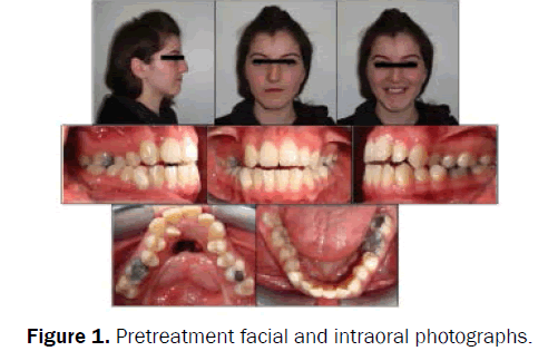 dental-sciences-Pretreatment
