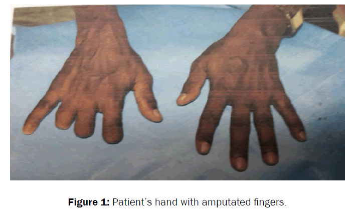 dental-sciences-amputated-fingers