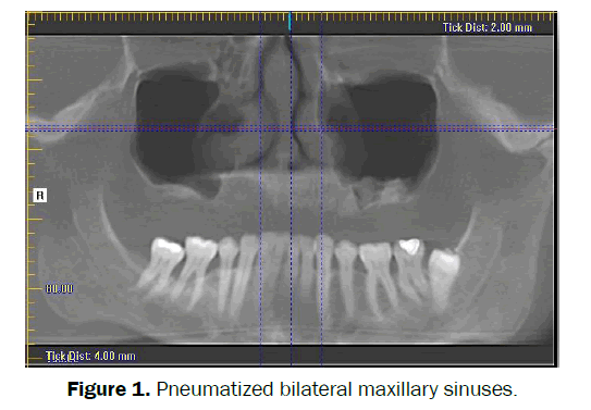 dental-sciences-bilateral-maxillary-sinuses