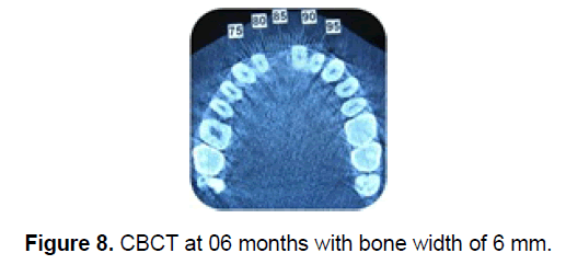 dental-sciences-bone-width