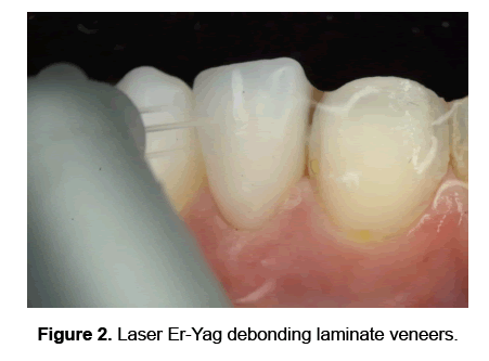 dental-sciences-debonding