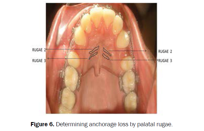 dental-sciences-determining-anchorage