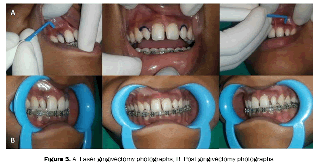 dental-sciences-gingivectomy