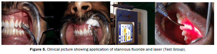 dental-sciences-groups-Clinical-picture-application-stannous
