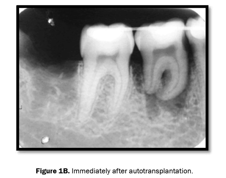 dental-sciences-immediately-after-autotransplantation