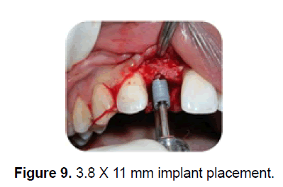 dental-sciences-implant-placement