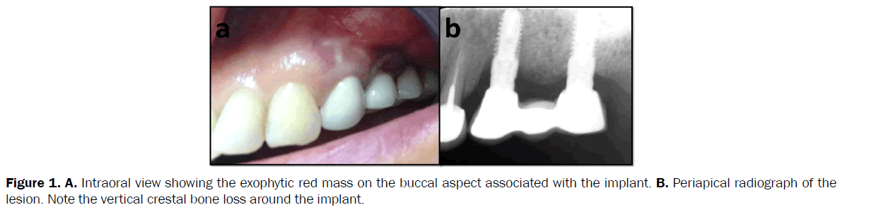 dental-sciences-loss-around-implant