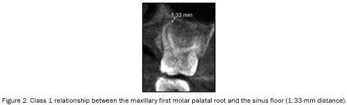 dental-sciences-molar-palatal-root