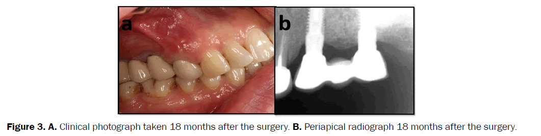 dental-sciences-months-after-surgery