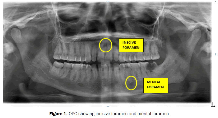 dental-sciences-opg-incisive-foramen