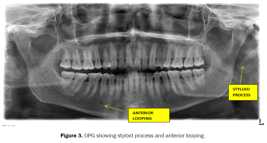 dental-sciences-opg-styloid-process