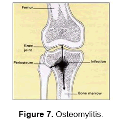 dental-sciences-osteomylitis