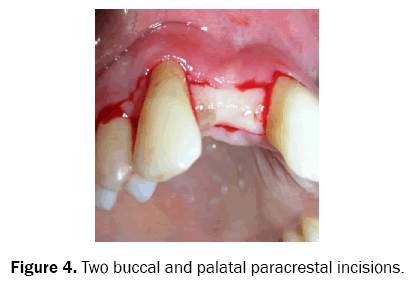 dental-sciences-paracrestal