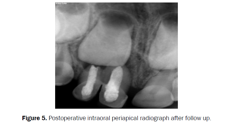 dental-sciences-periapical-radiograph