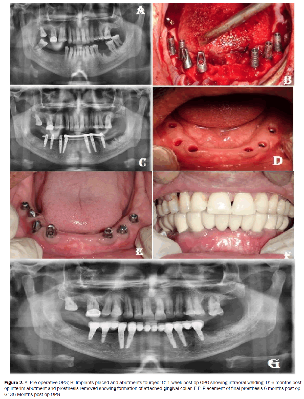 dental-sciences-pre-operative-implants