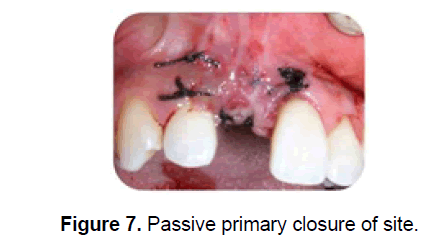 dental-sciences-primary-closure