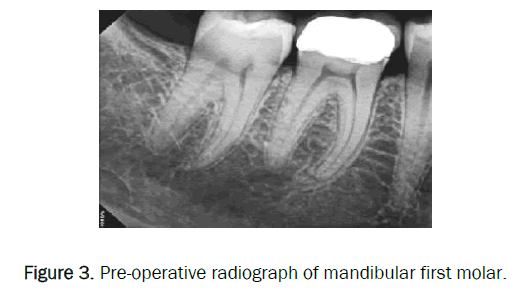 dental-sciences-radiograph-mandibular-first-molar