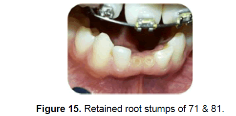dental-sciences-root-stumps