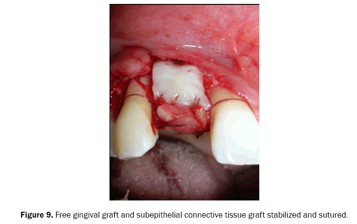 dental-sciences-subepithelial