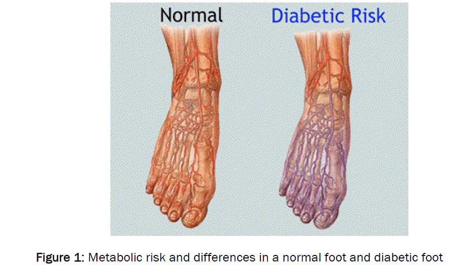 health-sciences-diabetic-foot