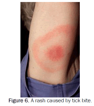 zoological-sciences-rash-caused-tick