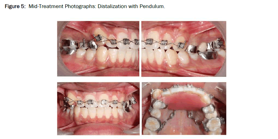 Dental-Sciences-Distalization