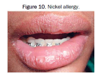 JDS-allergy