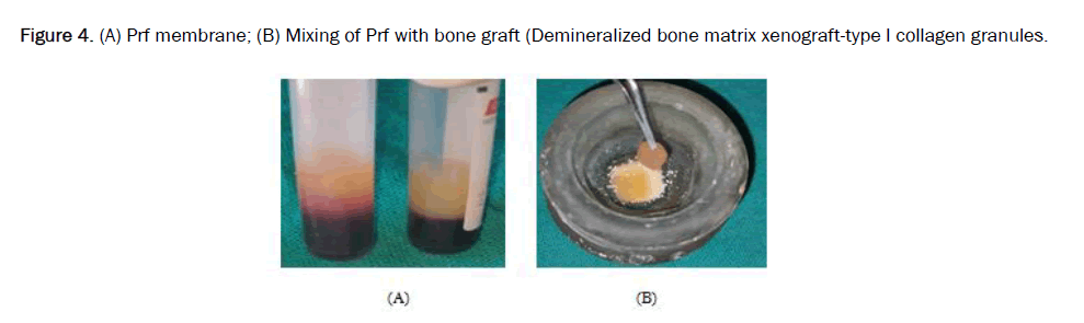 JDS-bone