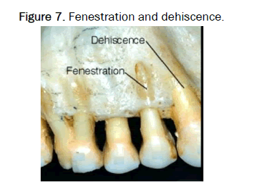 JDS-dehiscence