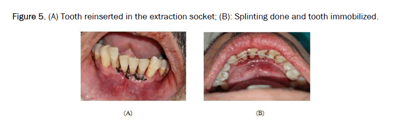 JDS-extraction