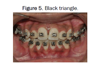 JDS-triangle