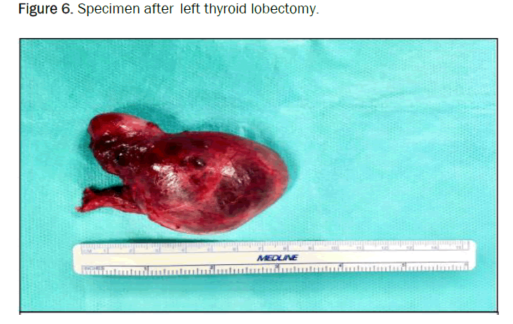 medical-case-lobectomy