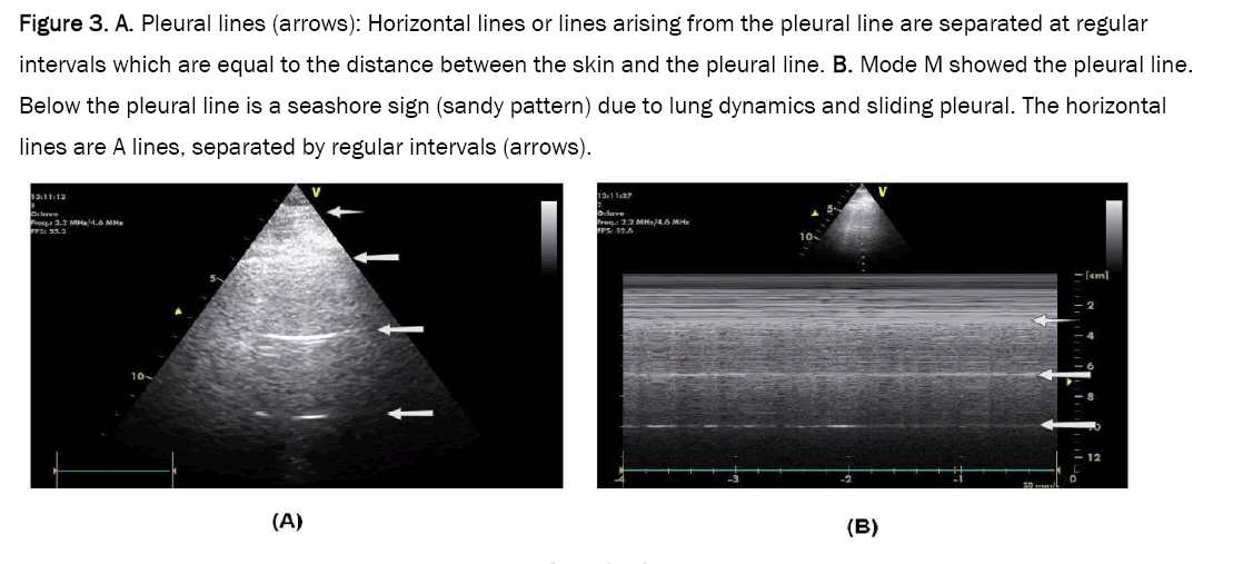 medical-case-pleural