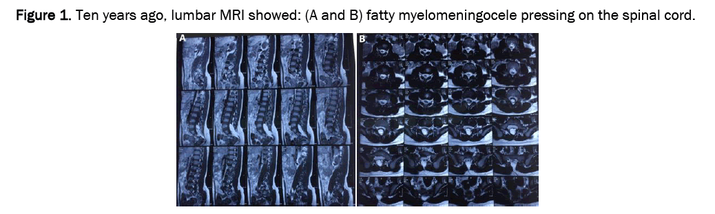 medical-health-myelomeningocele