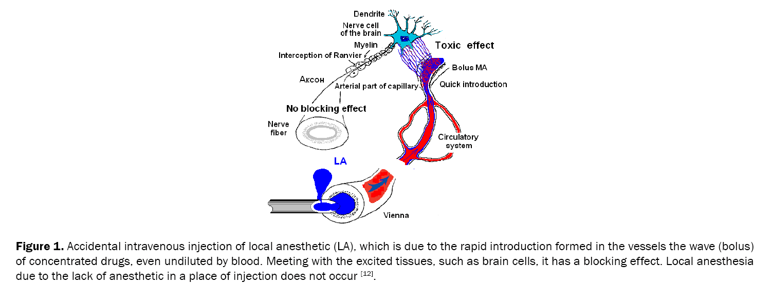 Dental-Sciences-Accidental-intravenous-injection-local-anesthetic