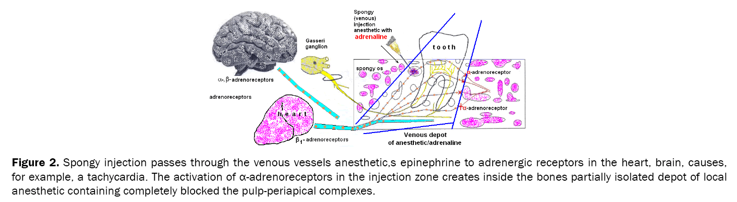 Dental-Sciences-Spongy-injection-passes-through-venous-vessels-anesthetic