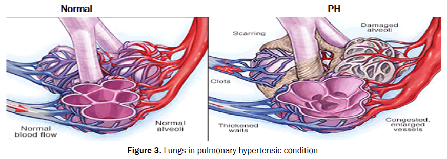 Medical-Health-root-filling-Lungs-pulmonary-hypertensic-condition