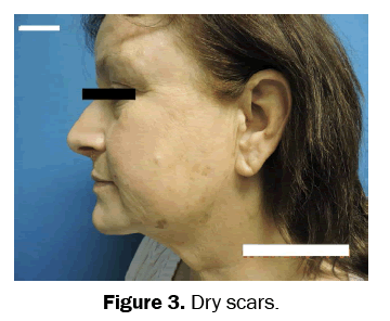 clinical-medical-Dry-scars