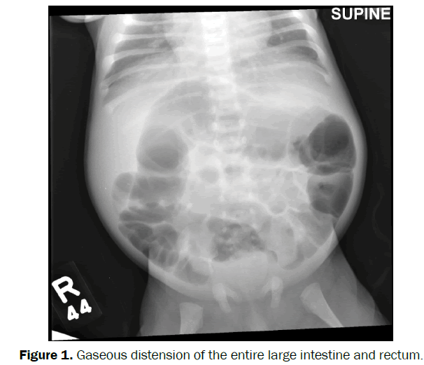 clinical-medical-Gaseous-distension